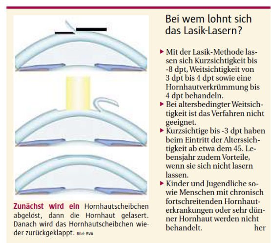 Laser orientiert sich an Landkarte des Auges