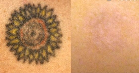 Fast als wäre das Tattoo nie da gewesen: Der neue Speziallaser entfernt Tätowierungen beinahe ohne Spuren zu hinterlassen.