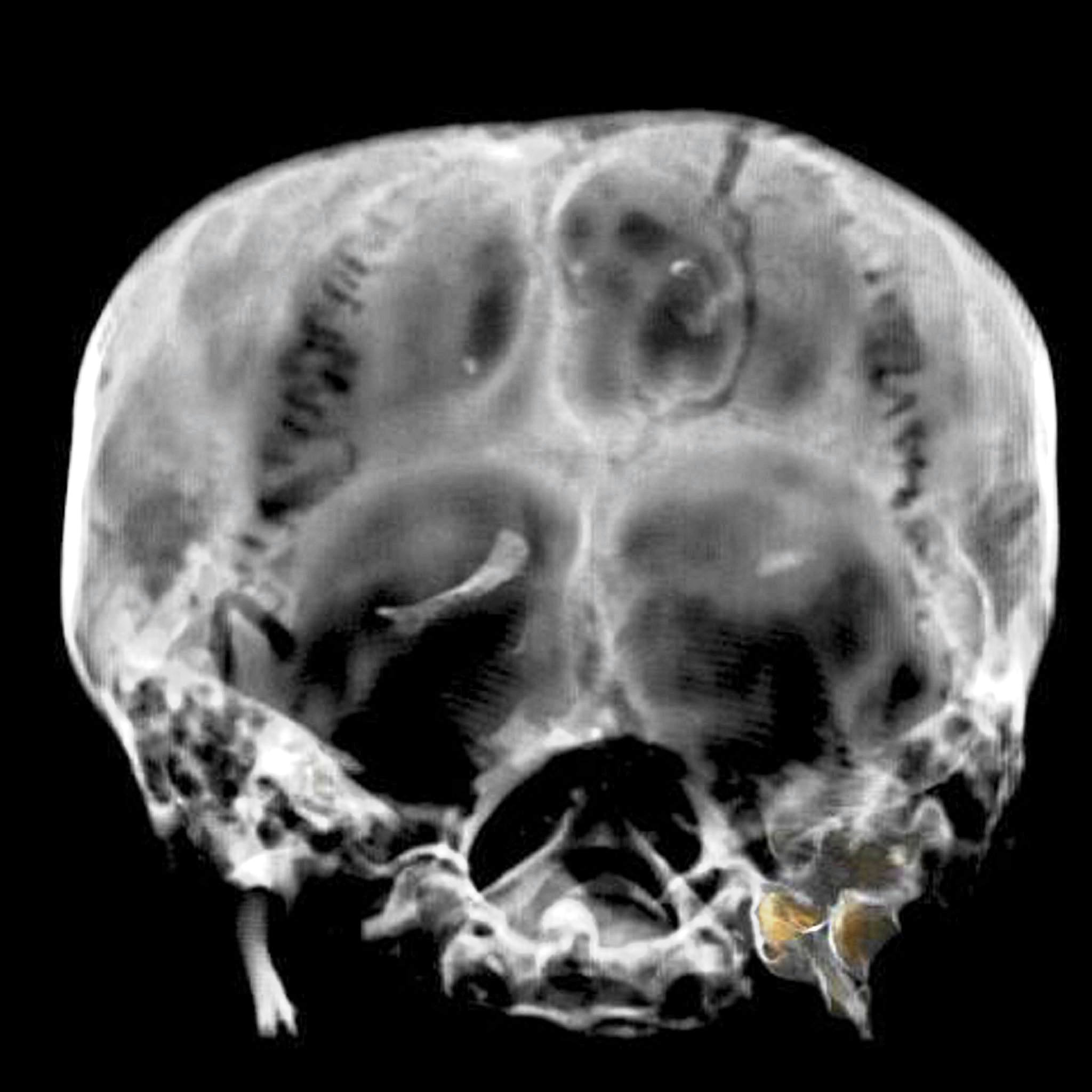 Computertomographie des Kopfes des Pharaos Tutanchamun im Jahr 2005: Erst jetzt sind Forscher der Todesursache des jungen Pharaos auf die Spur gekommen.