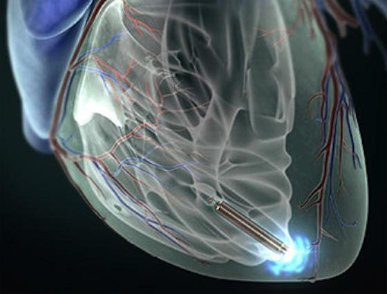 Der Herzschrittmacher Nanostim wird ohne Operation über ein Katheder direkt ins Herz eingeführt. Ohne Verkabelung stimuliert er den Herzmuskel, die Batterie hält 13 Jahre lang.