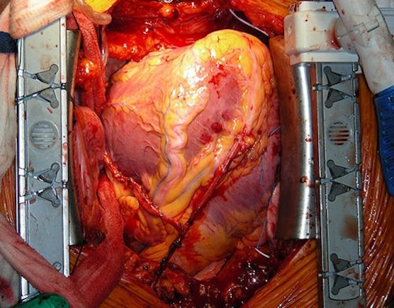 Operationen am offenen Herzen sind stets mit einem Risiko verbunden. Der Mini-Fallschirm hingegen lässt sich über eine Vene in die Herzkammer schieben. Erforderlich ist lediglich ein kleiner Schnitt am Oberschenkel. 