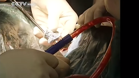 Die Ärzte aus Peking sind die weltweit ersten, die einen Wirbel aus dem 3D-Drucker implantieren. Dank 3D-Druck konnten die Designer Hunderte Poren in das Implantat einbauen, in die Gewebe einwächst. 