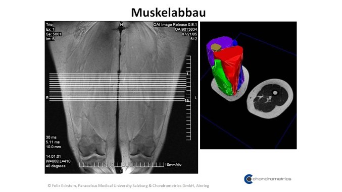 Bildliche Darstellung des Muskelabbaus.