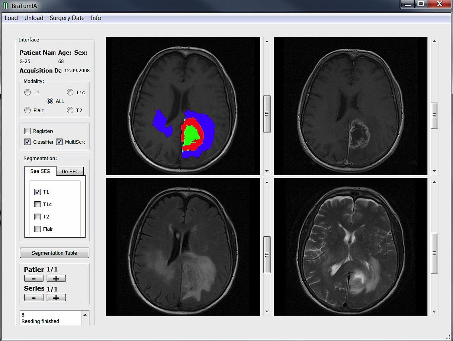 Die Software BraTumIA aus Bern: Sie liefert Neuroradiologen eine schnelle und exakte Bilddaten-Analyse bösartiger Gehirntumore.