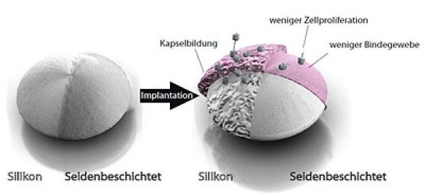 Ist das Brustimplantat unbeschichtet, entwickelt sich um die Silikonoberfläche eine starke Kapsel aus Narbengewebe. Auf der dünnen Haut aus Spinnenseide bildet sich deutlich weniger Bindegewebe.