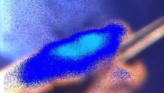 Durch die Hightech-Brille betrachtet leuchten die Krebszellen blau.