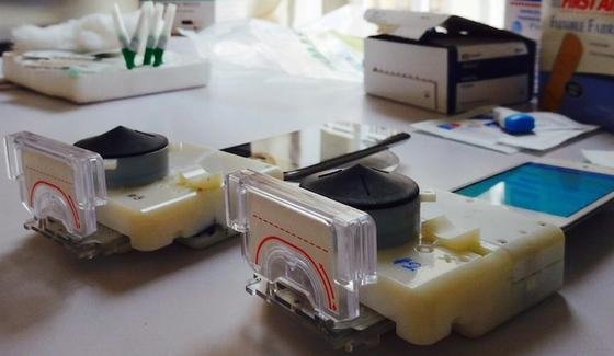 Das Minilabor fürs Smartphone spürt HIV- und Syphilis-Antikörper in wenigen Minuten auf.