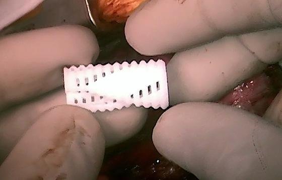 Eines der ersten Luftröhrenimplantate aus dem 3D-Drucker: Die Implantate halten drei Jahre und lösen sich dann auf.