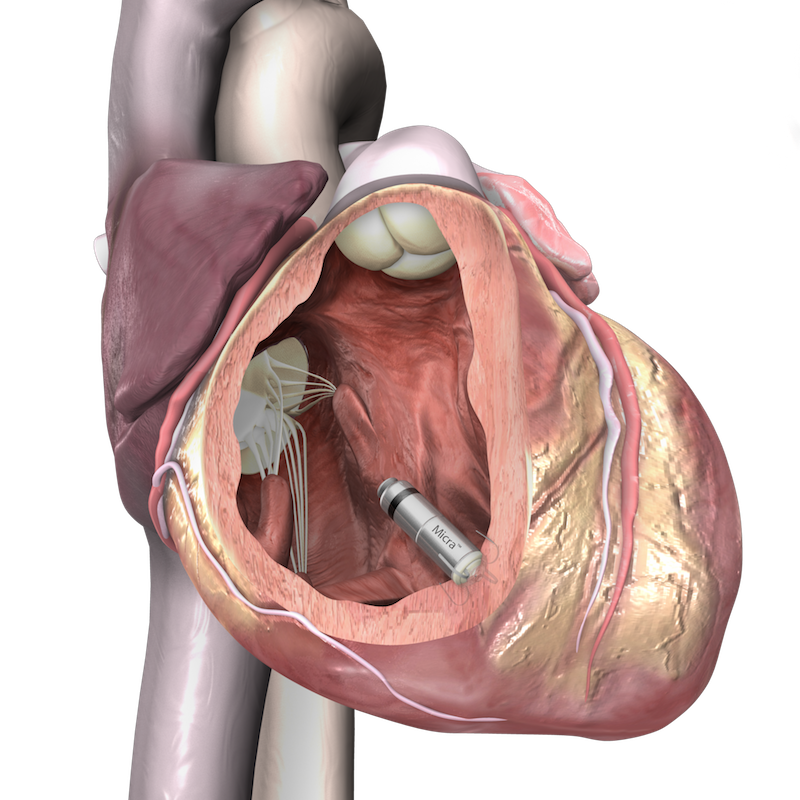 Der kleinste Herzschrittmacher der Welt wird über ein Kathedersystem an der Herzinnenwand platziert. Die filigranen Titanhäkchen verankern sich dort.