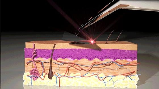 Erste Sahne: Eine Rasur mit dem Laser Razor hinterlässt keine unschönen Spuren. Weder im Gesicht, noch an sonstigen empfindlichen Stellen. Die Ingenieure habe eine Wellenlänge gefunden, die Chromophoren im Haar zerstört ­– die Haut bleibt unversehrt. 