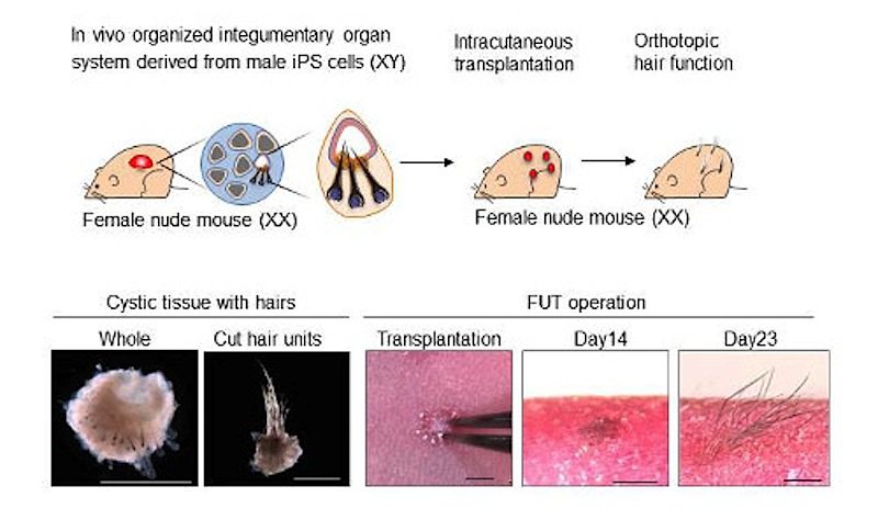 Schematische Darstellung der Haarzellentransplantation.