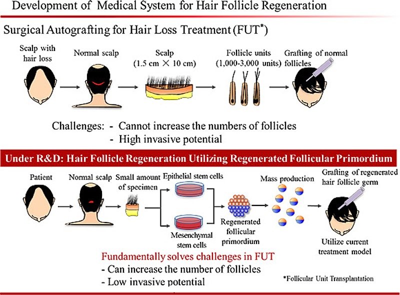 Grafische Darstellung zu den einzelnen Schritten der Haarzellentransplantation. 