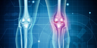 Illustration geschädigtes Knie