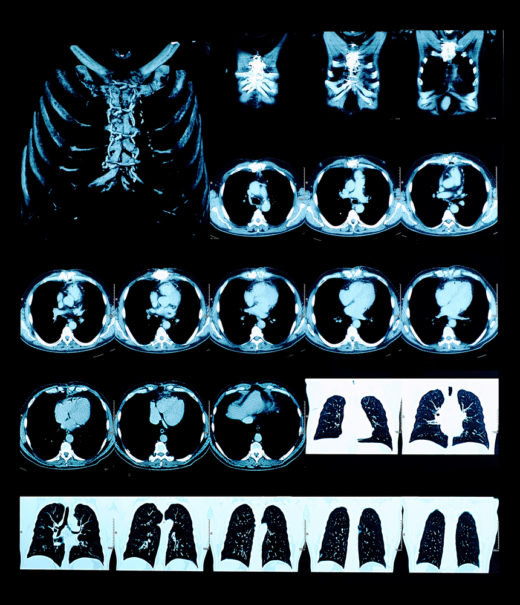 Anonymisierte Patienten-Bilder erhalten die Forschenden von kooperierenden Kliniken. Die KI lernt, kleinste Anomalien auf den Aufnahmen zu erkennen und zu deuten. Foto: Panthermedia.net/sudok1