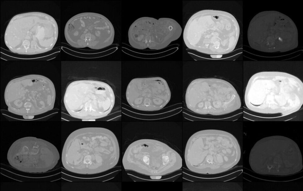 Erste Trainingsergebnisse: Aus zahlreichen echten Patientendaten wurden erste synthetische CT-Aufnahmen vom Abdomen erstellt.
Foto: Daniel Truhn / Universitätsklinikum Aachen