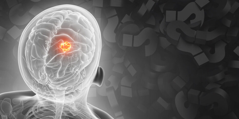 Blick ins menschliche Gehirn mit Tumor