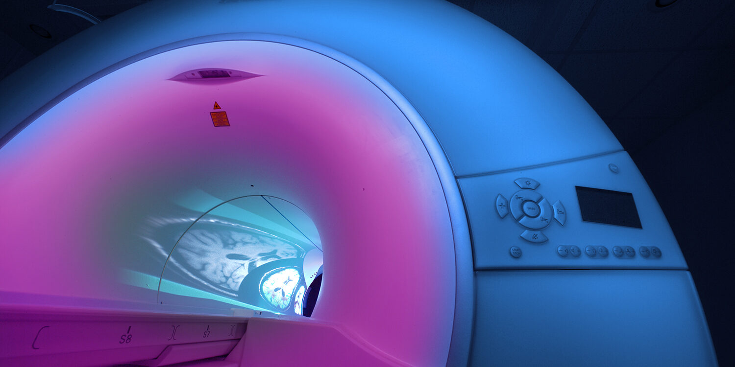 Neues KI-Werkzeug erkennt Hirntumore schneller als der Arzt