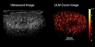 Das Bild zeigt die herkömmliche Ultraschallmethode sowie die Ultraschall-Lokalisations-Mikroskopie (re.) anhand einer Mausniere.