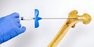 Hydrogel gegen Osteoporos