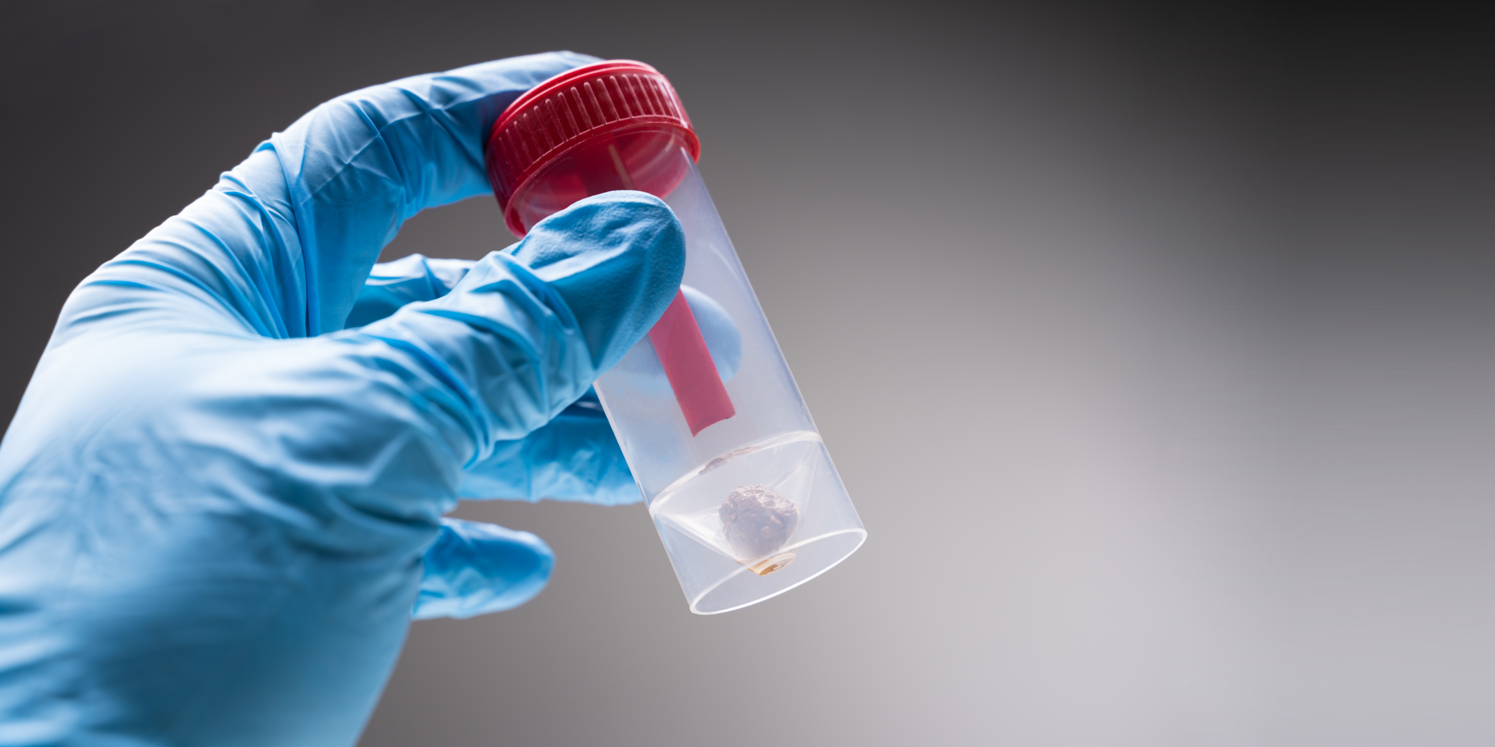 Darmkrebs per App erkennen – funktioniert das wirklich?