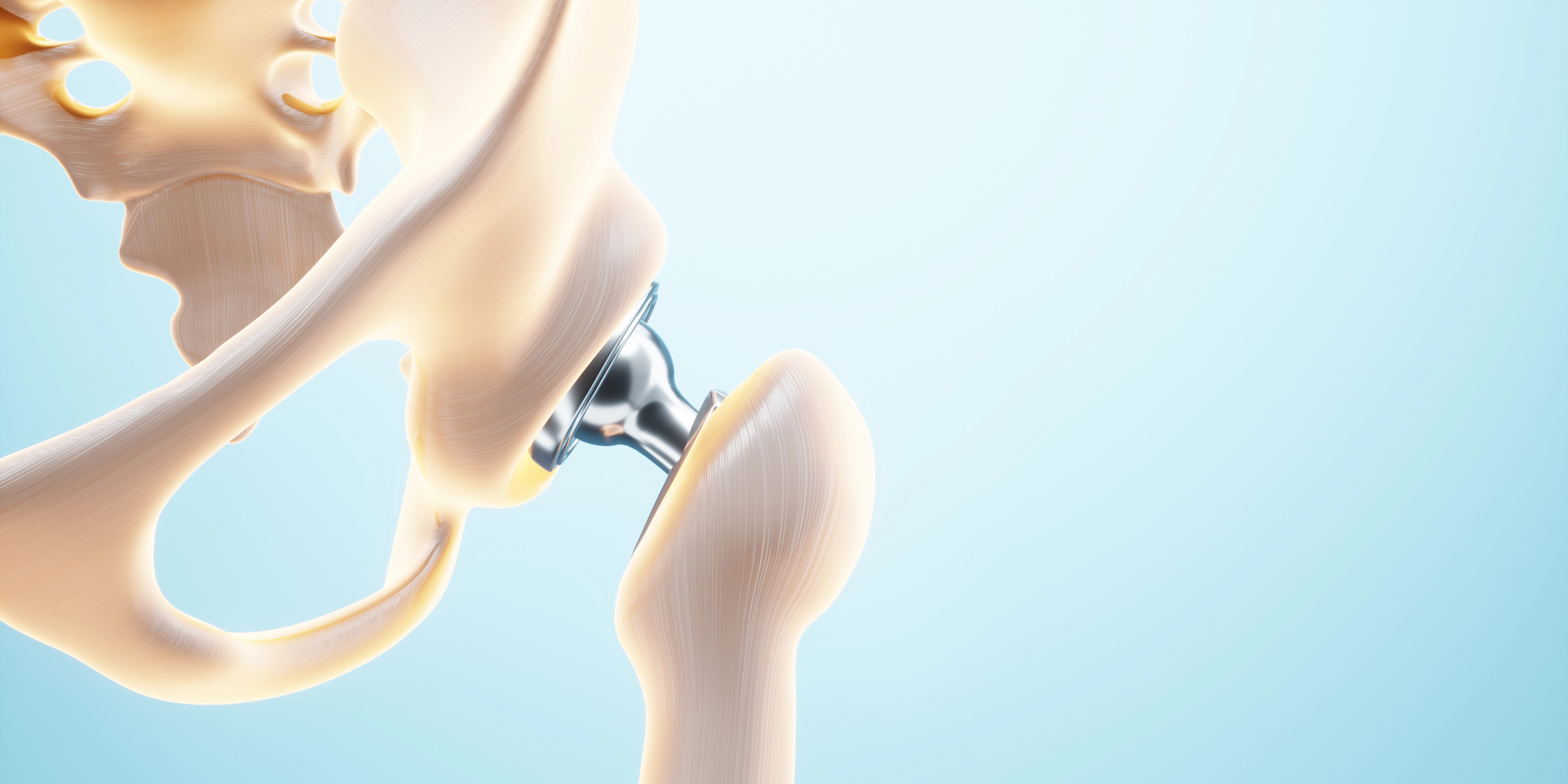 3D-Druck macht Knochenimplantate superelastisch