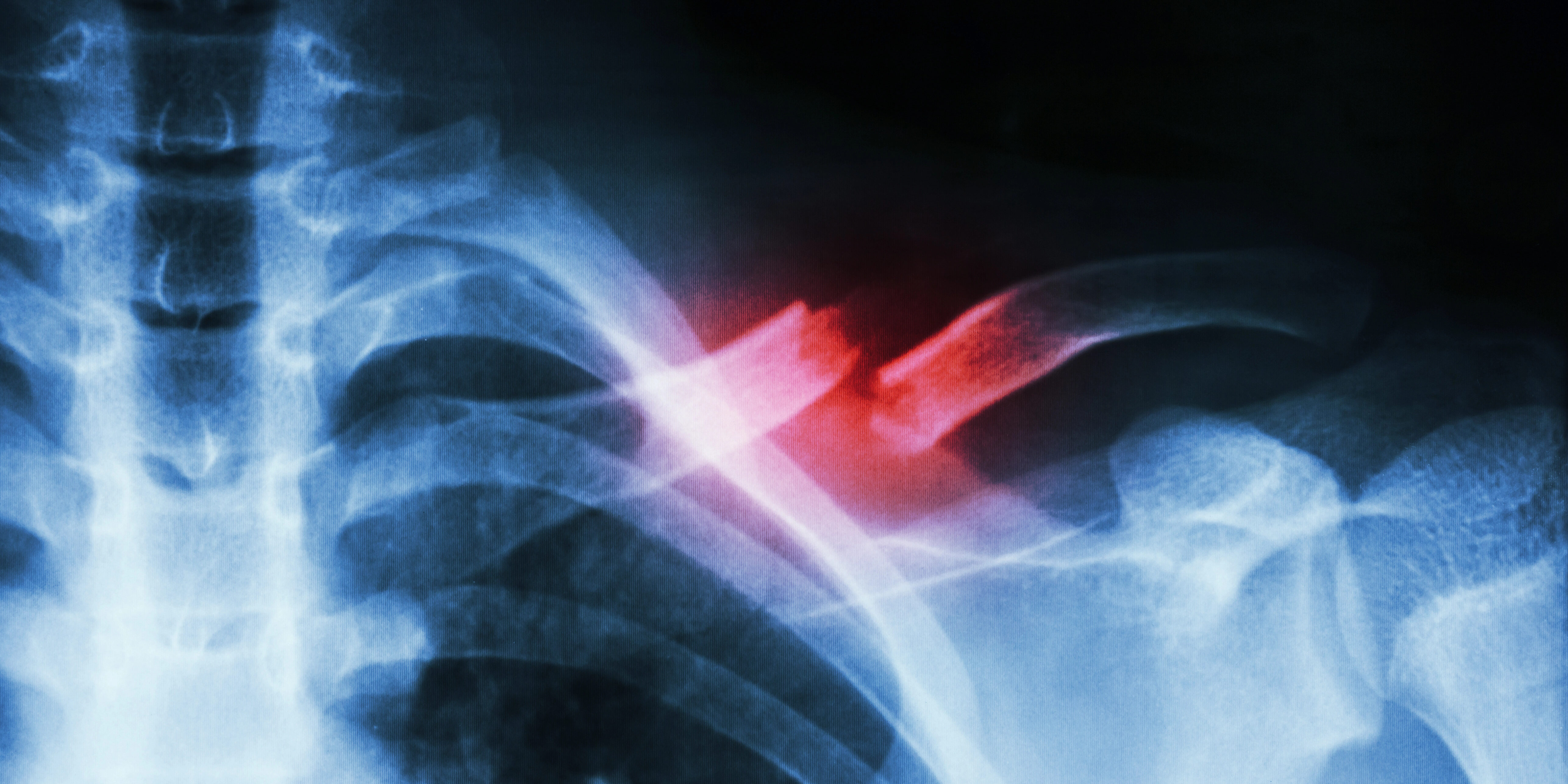 Abbaubares Implantat lässt Knochen schneller heilen