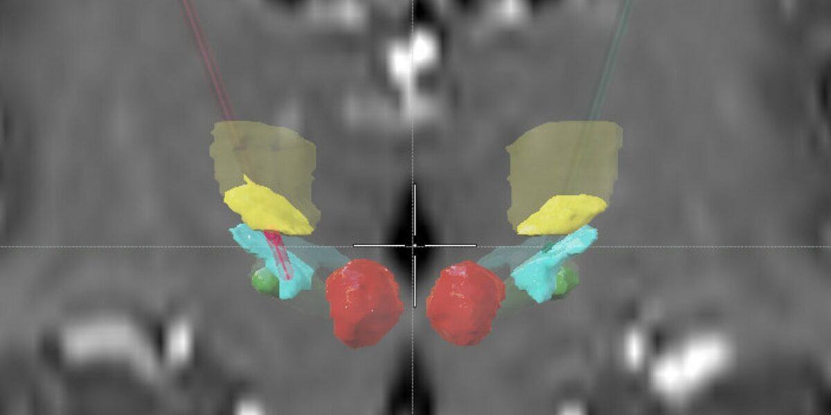 Elektroden im Gehirn