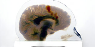Ein medizinisches Scan-to-Print-Modell