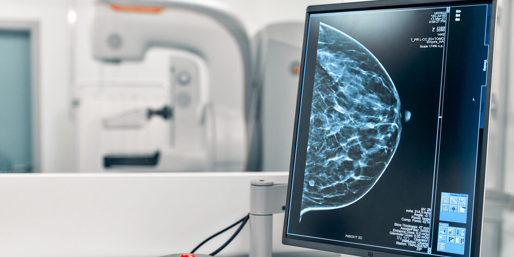 KI sagt Brustkrebsrisiko voraus