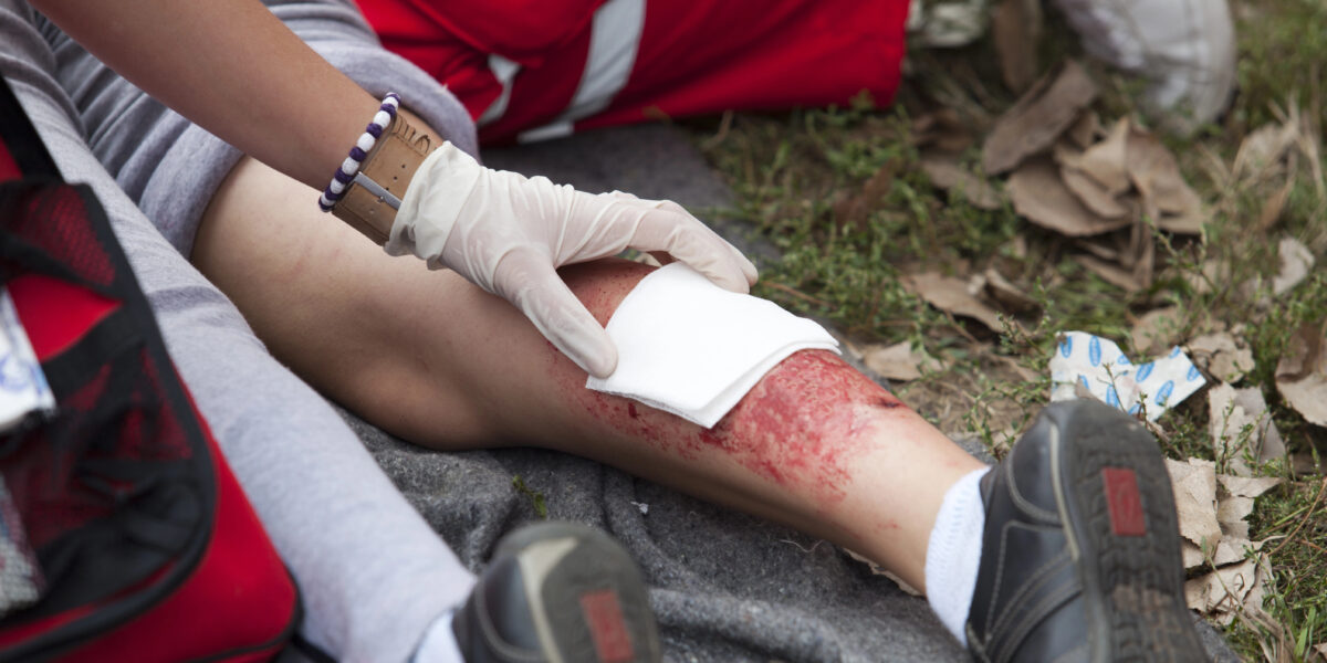 Behandlung einer Brandverletzung
