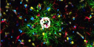 Fluoreszenzmikroskopische Aufnahme von Gehirngewebe mit Alzheimer-Plaques (weiß), umgeben von aktivierten Immunzellen (grün) und Nervenzellen.