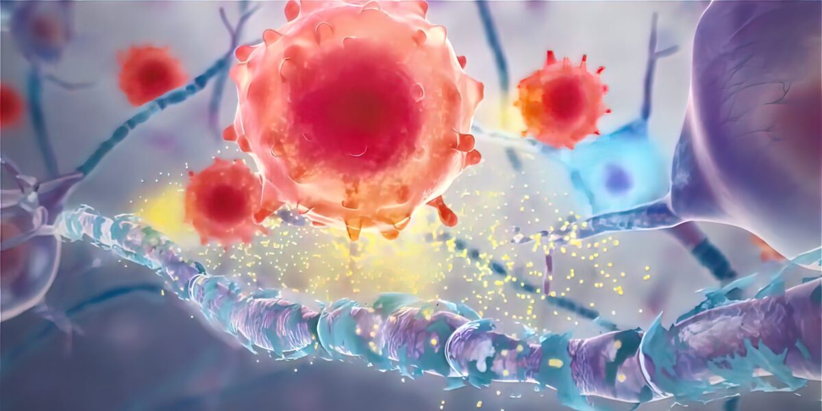 Illustrative Darstellung von Multipler Sklerose im Nervensystem