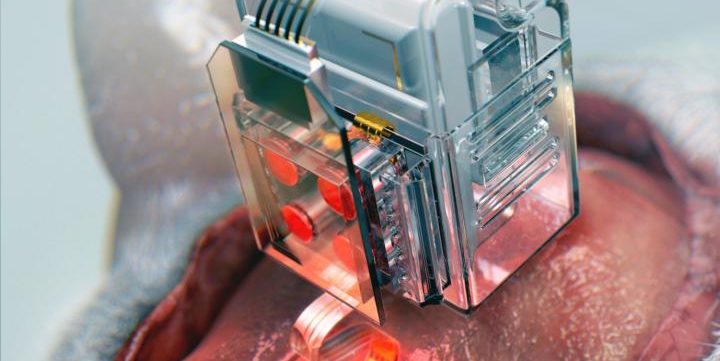 Das Gehirn per Implantat und Smartphone behandeln
