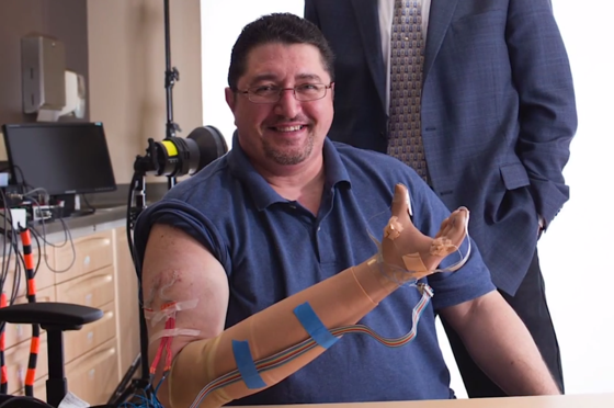 US-Ingenieure entwickeln Handprothese mit Tastsinn