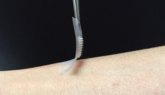 Insulinpflaster aus den USA soll die Spritze ersetzen