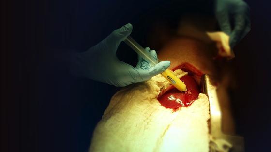 So schnell kann man mit Algengel eine Blutung stoppen