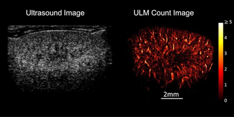 Fünffach bessere Ultraschallbilder