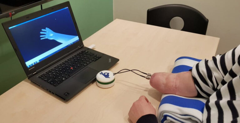 Erste Handprothese mit sensiblem Tastsinn