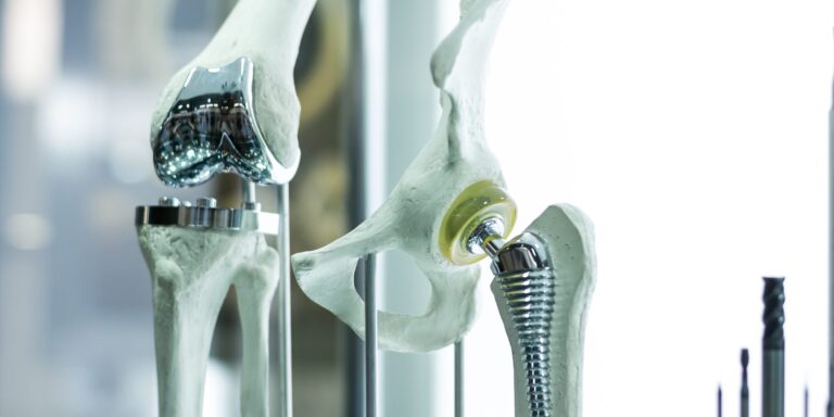 Warum manche Prothesen und Implantate früher ausgetauscht werden müssen