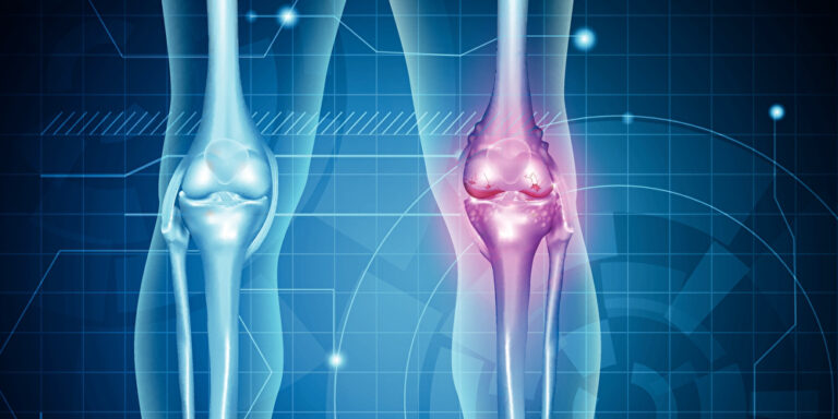 Schalldiagnostik könnte frühe Therapie einer Arthrose ermöglichen