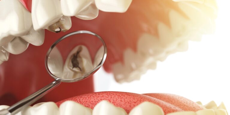 Wie 3D-Optik die Kariesdiagnostik verändern soll